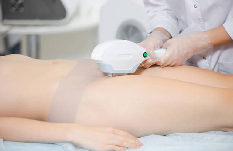 ビキニラインのムダ毛は自己処理より光脱毛がおススメ