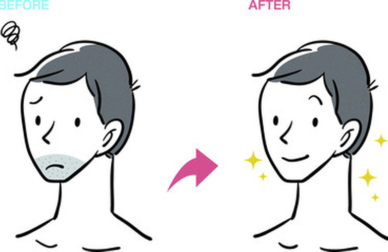 男性の髭（ひげ）脱毛は痛みの少ない光脱毛がおすすめ！